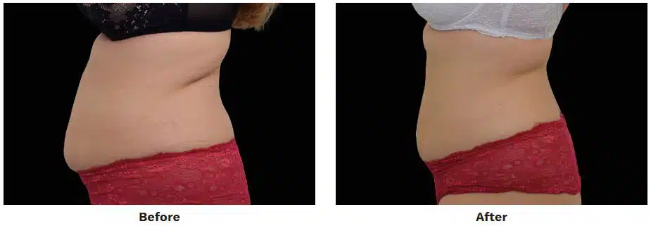 Before and After EMSculpt Neo Abdomen