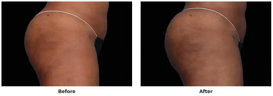 Before and After EMSculpt Neo Abdomen