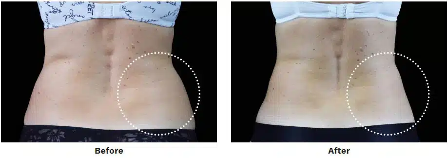 Before and After EMSculpt Neo Abdomen Treatment