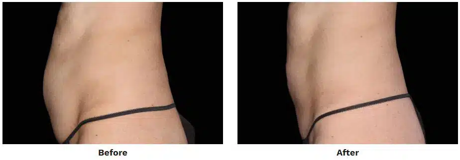 Before and After EMSculpt Neo Abdomen