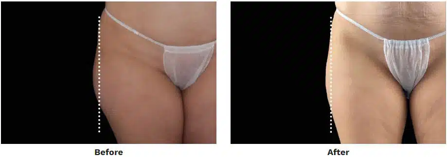 Before and After EMSculpt Neo Outer Thighs