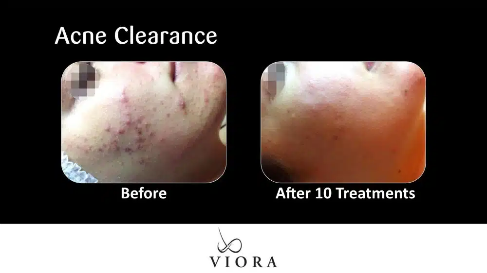 Before and After Viora Acne Clearance