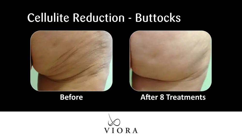 Before and After Viora Cellulite Reduction Buttocks