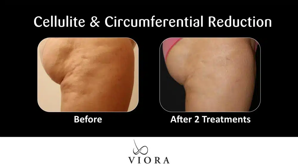 Before and After Viora Cellulite and Circumferential Reduction