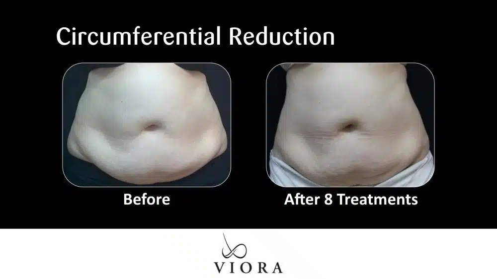 Before and After Viora Circumferential Reduction