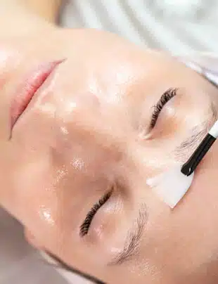 Chemical Peels