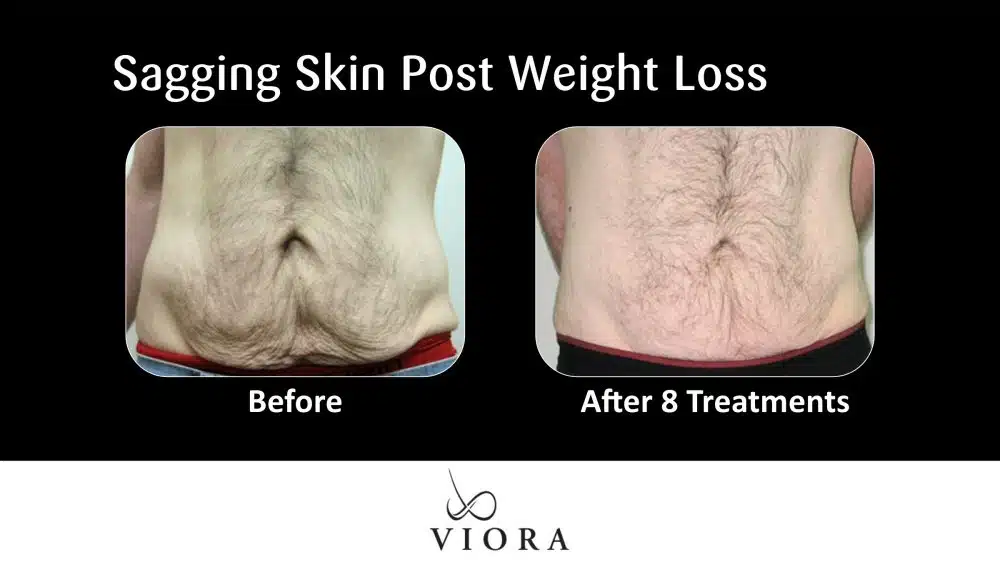 Before and After Viora Sagging Skin Post Weight Loss