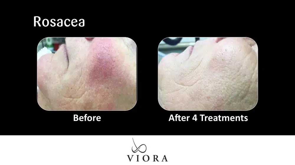 Before and After Viora Rosacea Treatment
