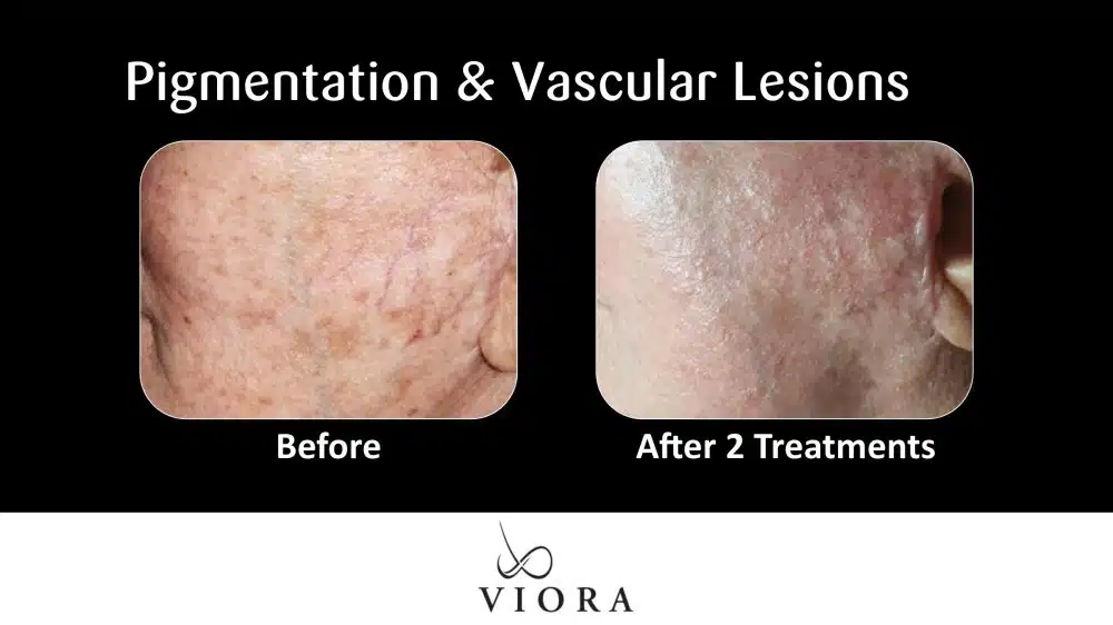 Before and After Viora Rosacea Treatment Pigmentation and Vascular Lesions