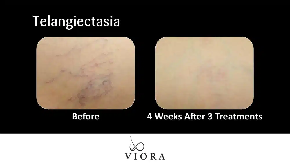 Before and After Viora Rosacea Treatment Telangiectasia