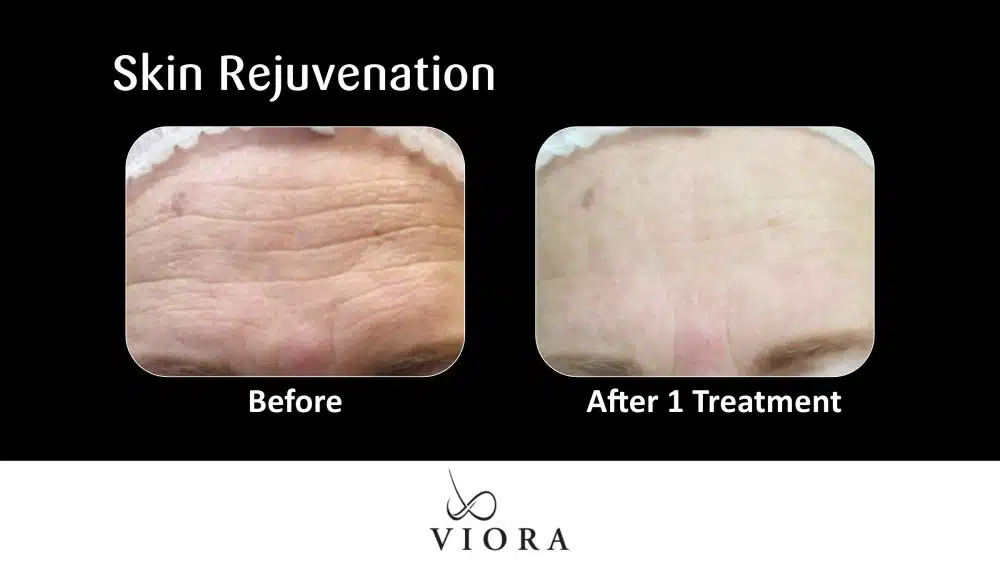Before and After Viora Rosacea Treatment Skin Rejuvenation