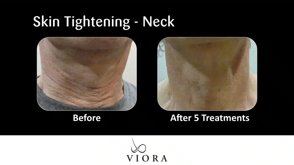 Before and After Viora Skin Tightening Neck