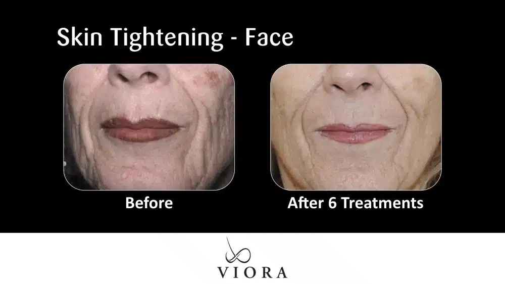 Before and After Viora Skin Tightening Face