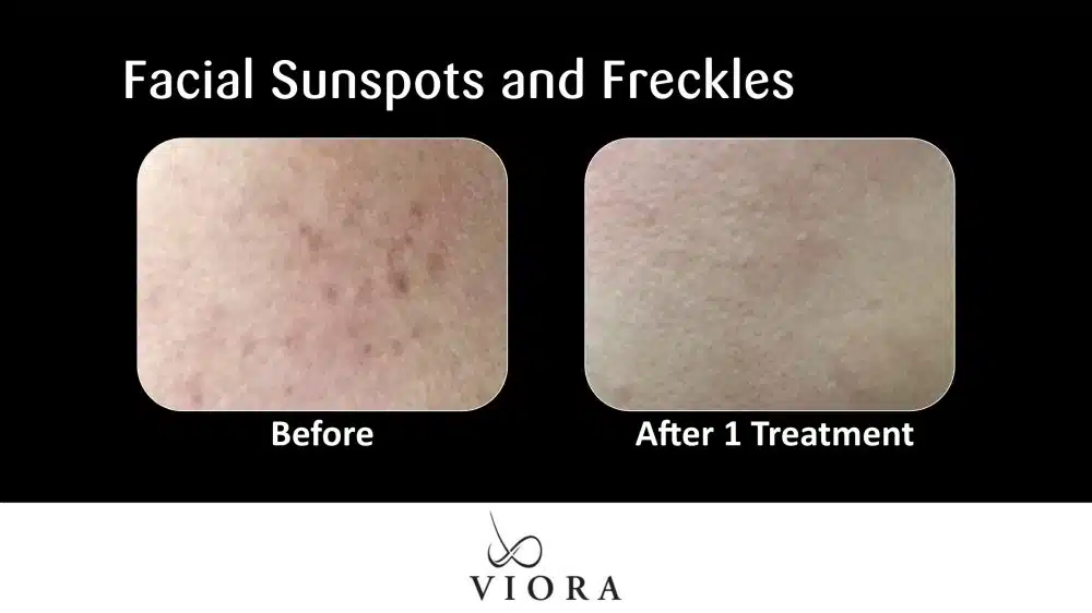Before and After Picture Viora Sun Spots Treatment Facial Sunspots and Freckles
