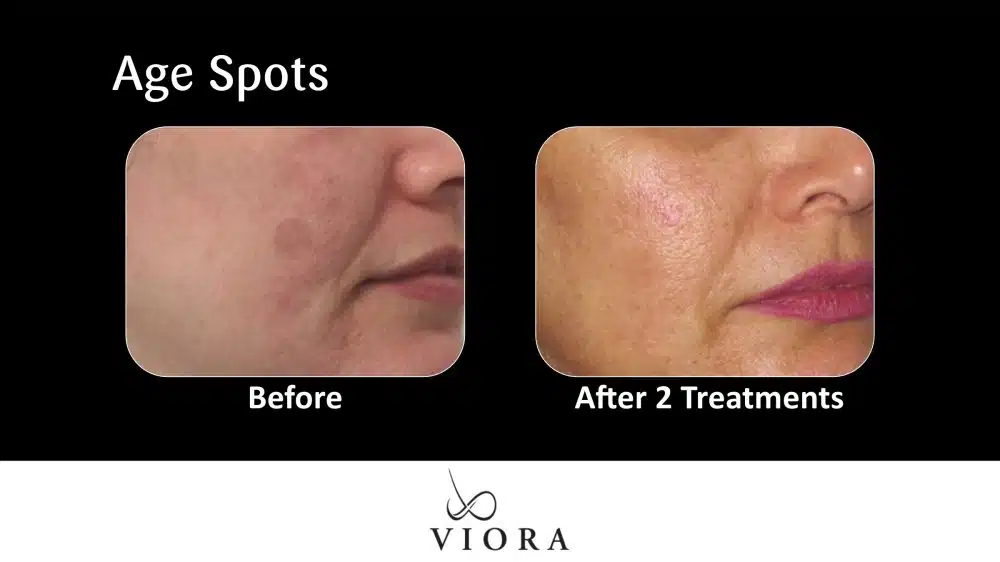 Before and After Picture Viora Sun Spots Treatment Age Spots