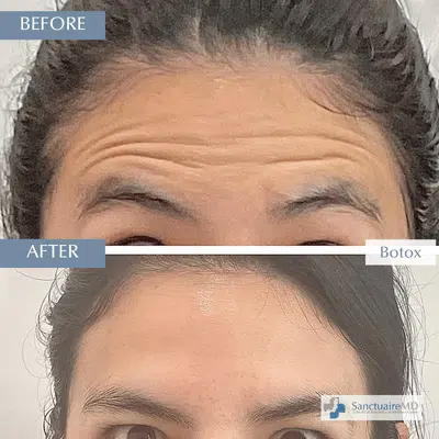 Botox for Frown Lines