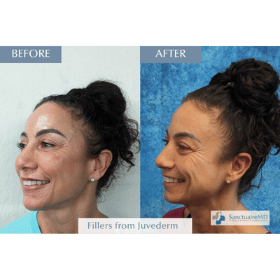 Juvederm fillers before and after
