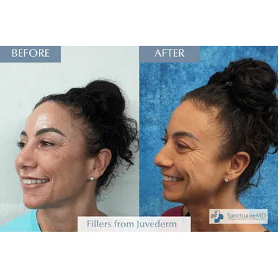 Juvederm fillers before and after