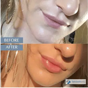 Juvederm fillers before and after