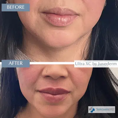 Juvederm ultra xc before and after