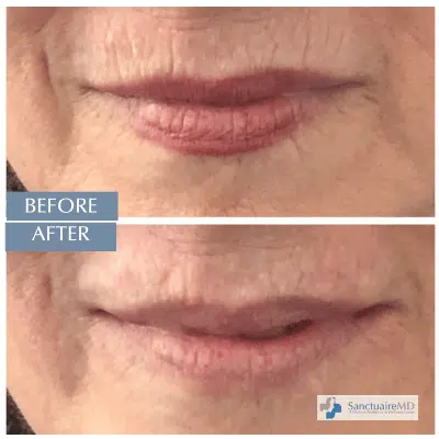 Perioral lines treatment using Juvederm fillers
