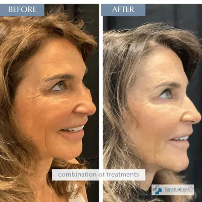 Juvederm fillers Volbella Before and After
