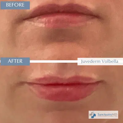 Juvederm fillers Volbella Before and After