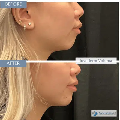 Voluma Filler Before and After