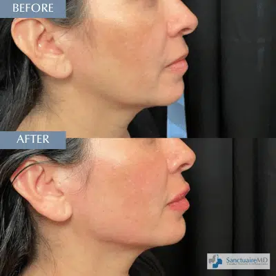 juvederm lip fillers before and after