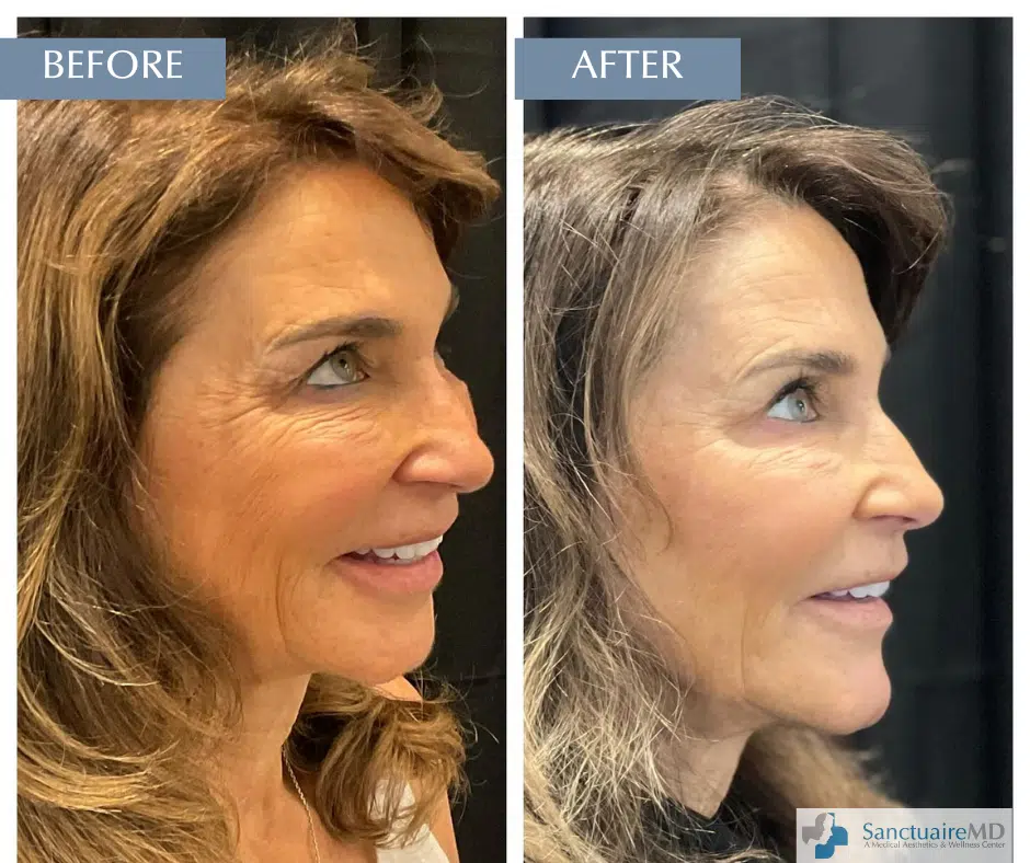 Botox before and after pictures