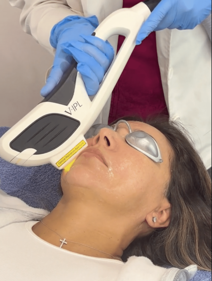 Sanctuaire MD IPL Photofacial
